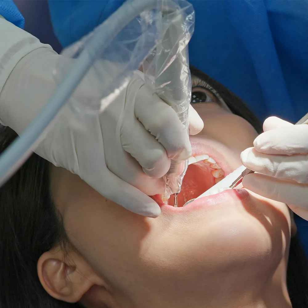 Root Canal