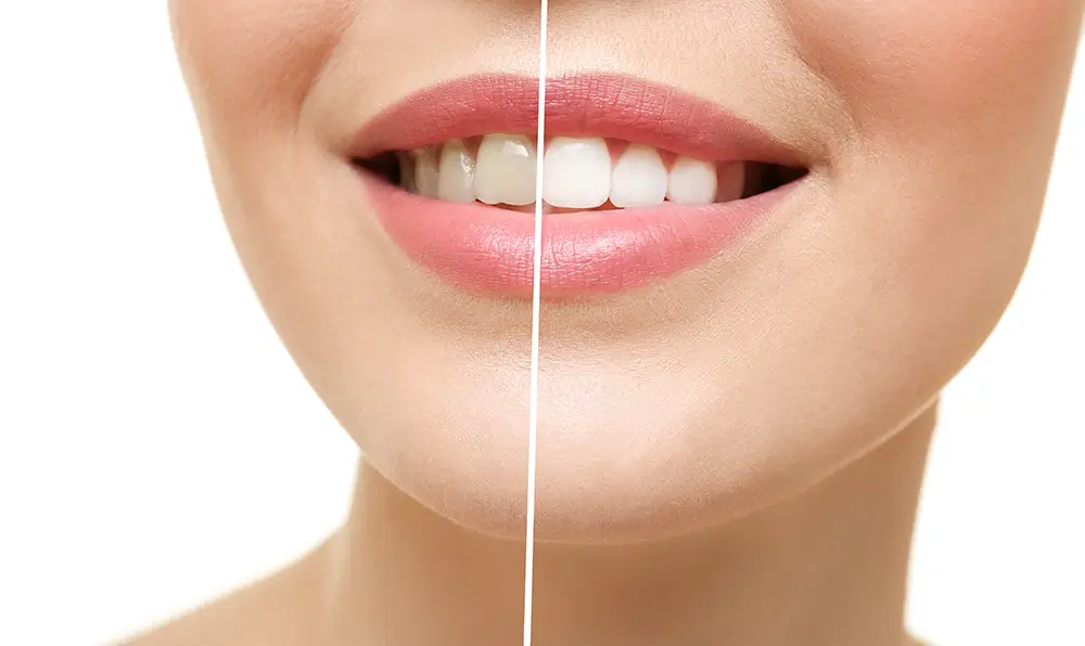 Teeth Bleaching in Montana